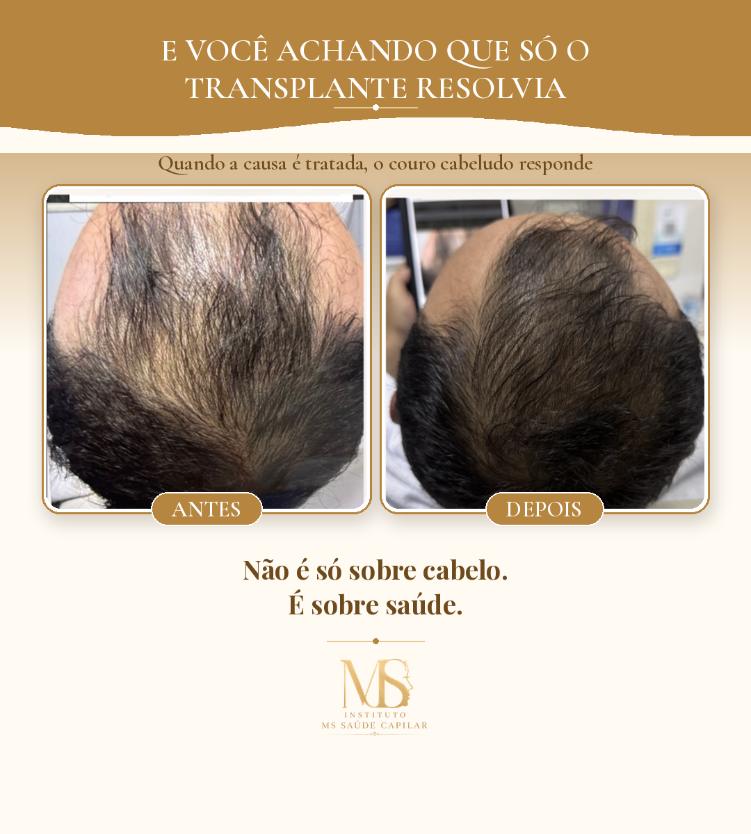 Antes_Depois_1_Transplante
